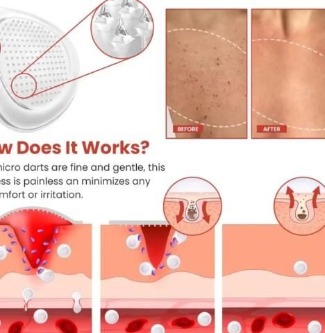 Skin Tag Remover Patch - TRENZY CART