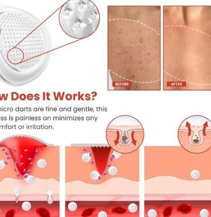 Skin Tag Remover Patch - TRENZY CART