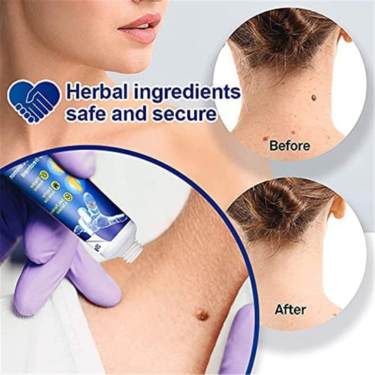 WartsOff Instant Blemish Removal Cream Pack of 2 - TRENZY CART